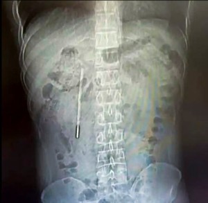 Đi viện vì đau dạ dày, người đàn ông bất ngờ phát hiện chiếc nhiệt kế thủy ngân nằm trong bụng suốt hai mươi năm