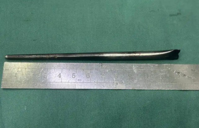 Người đàn ông sống 8 năm với chiếc đũa trong cổ họng và cái kết khiến cộng đồng mạng không thể tin nổi - Ảnh 1.