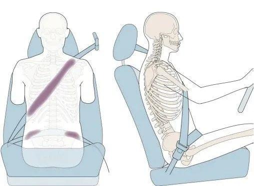 Hội chứng dây đai an toàn và những góc khuất nguy hiểm ít người biết từ thiết bị cứu mạng - Ảnh 2.
